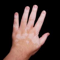 hand with Vitiligo skin condition photo