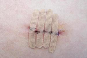 skin with suture and wound closure strips or surgical tape photo