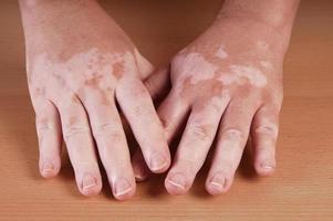 Vitiligo on male hands photo