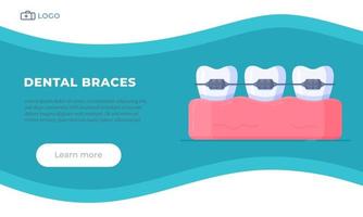 Vector illustration of dental braces. Alignment of teeth.