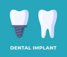 ilustración vectorial de un implante dental. aislado en un implante dental de fondo azul. vector