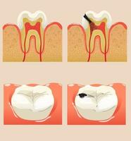 conjunto de dientes con caries vector illustraion