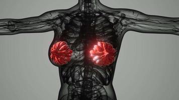 analyse médicale du cancer du sein chez la femme