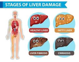 Diagram showing stages of liver damage vector