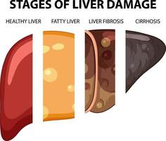 Diagram showing stages of liver damage vector