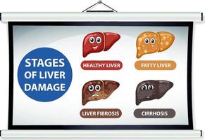 Diagram showing stages of liver damage vector