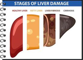 Diagram showing stages of liver damage vector