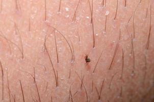 tick on skin with hair photo