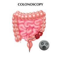Colonoscopy Realistic Poster vector
