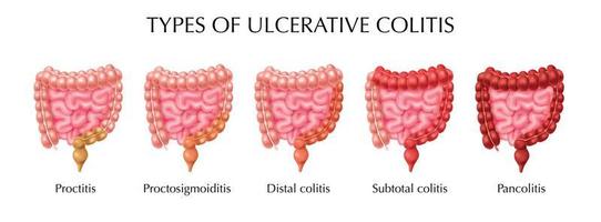 infografía de tipos de colitis ulcerosa vector