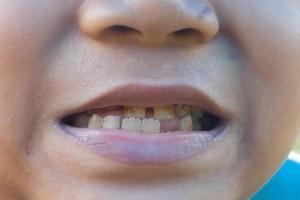 yellow teeth belonging to a boy who is still growing