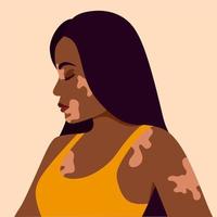 Vitiligo is a young dark-skinned woman with skin problems. Skin diseases. The concept of World Vitiligo Day. Different skin colors of female characters. For a blog, articles, banner, magazine. vector