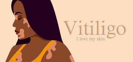 Vitiligo is a young dark-skinned woman with skin problems. Skin diseases. The concept of World Vitiligo Day. Different skin colors of female characters. For a blog, articles, banner, magazine. vector