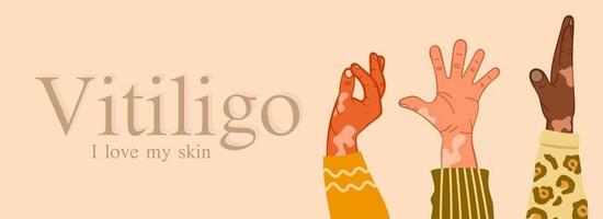 vitiligo tres manos de diferentes razas con problemas de piel. Enfermedades de la piel. el concepto del día mundial del vitíligo. diferentes colores de piel de personajes femeninos. para un blog, artículos, banner, revista. vector