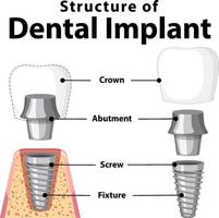 infografía de humanos en la estructura del implante dental. vector