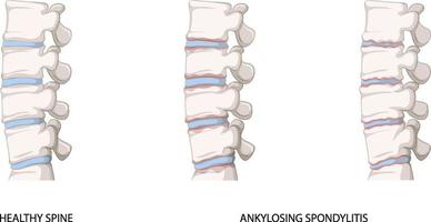 infografía de columna sana y espondilitis anquilosante vector