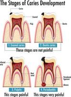 infografía de humanos en etapas de desarrollo de caries vector