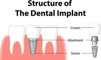 Infographic of human in structure of the dental implant vector