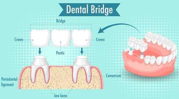 Infographic of human in dental bridge vector