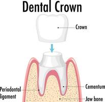 infografía de humano en corona dental vector