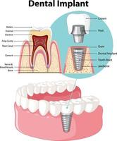 infografía de humanos en la estructura del implante dental. vector