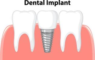 implante dental en la encía sobre fondo blanco vector