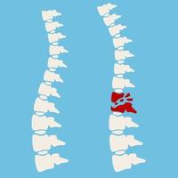 Problems with spine. Posture issues vector