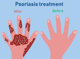 Stages of psoriasis formation. Treatment of psoriasis before and after vector