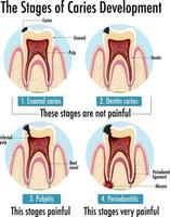 infografía de humanos en las etapas de desarrollo de caries vector