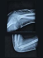 Broken arm xray photo