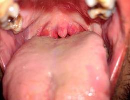 Human swollen throat photo