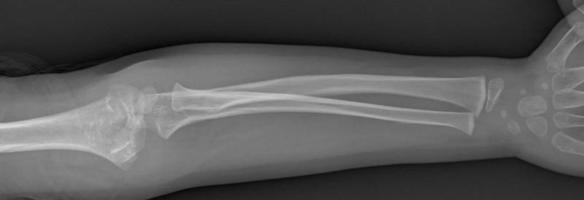 Broken arm xray photo