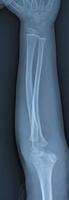 Broken arm xray photo