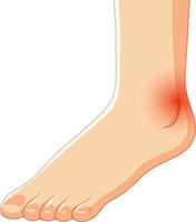 Achilles tendo rupture on white background vector