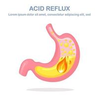 Human stomach. Gastroesophageal reflux disease. GERD, heartburn, gastric infographic. Acid moving up into the esophagus. Vector flat design