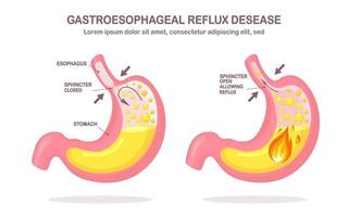 Human stomach. Gastroesophageal reflux disease. GERD, heartburn, gastric infographic. Acid moving up into the esophagus. Vector flat design