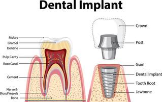 infografía de humanos en la estructura del implante dental. vector