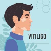 Vitiligo disease. Vector illustration in a flat style. A guy with skin depigmentation.