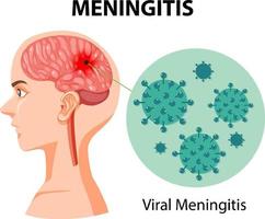 diagrama que muestra la meningitis en el cerebro humano vector