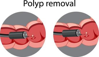 Diagram showing polyp removal vector