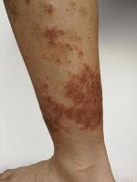 Young boy has Chronic rash on skin. Grass allergic skin disease. Atopic dermatitis. Age spot skin photo