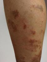 Young boy has Chronic rash on skin. Grass allergic skin disease. Atopic dermatitis. Age spot skin photo