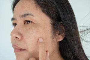Close up of Asian adult woman face has freckles, large pores, blackhead pimple and scars problem from not take care for a long time. Soft focus of skin problem face. Treatment and Skincare concept photo