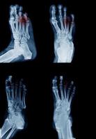 amputee foot x-ray image in many view photo