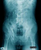 x-ray image adomen show pelvic bone photo