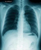 chest x-ray show inside of lung photo