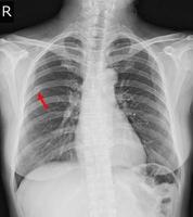 Chest x-ray Fracture right posterior 6th rib and possible fracture lateral aspect of left 9th rib. photo