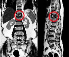 MRI Thoracic lumbar spine show moderate pathological compression fracture of T12 level. photo