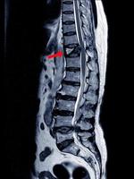 La resonancia magnética de la columna lumbar torácica muestra una fractura por compresión patológica moderada del nivel t12. foto