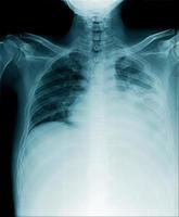 chest x-ray show many secretion in lower lobe and middle lobe of lung photo